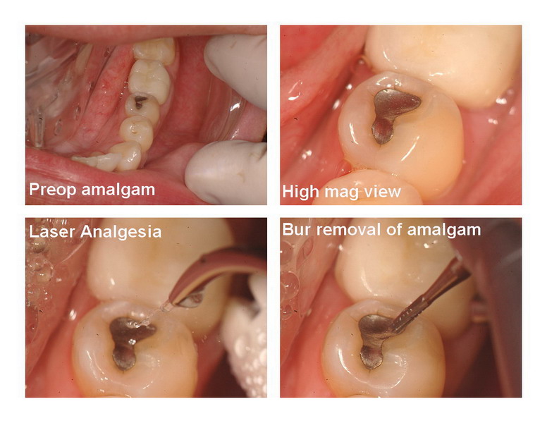 Amalgam removal 1_resize.jpg